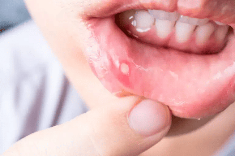 canker sore